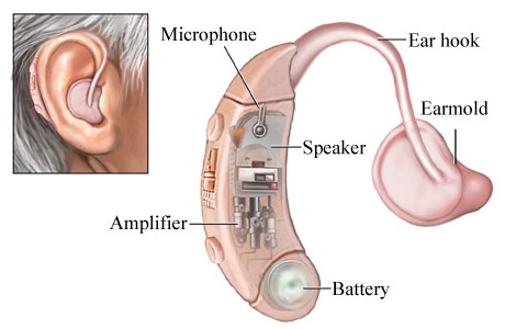 Hearing-aid-technology